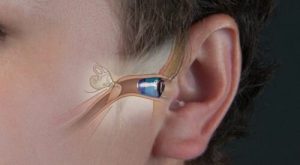 Coupe anatomique de l'oreille montrant un appareil auditif intra-auriculaire inséré dans le conduit auditif
